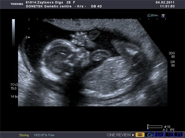 Фото ребенка на 19 неделе беременности фото узи